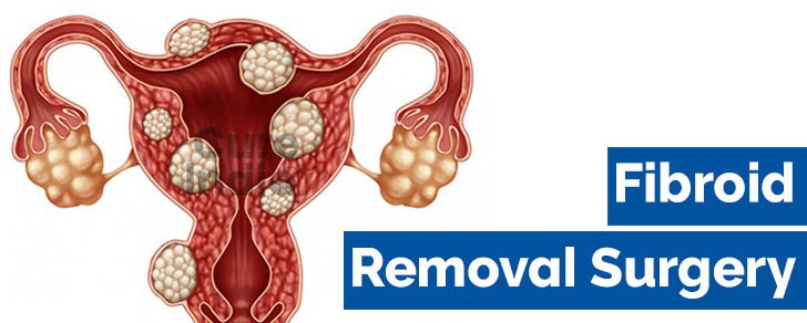 fibroid removal surgery in india